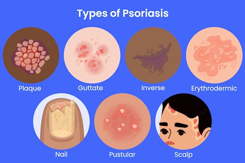Psoriasis